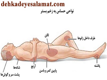 نواحی حساس برای ایجاد زخم بستر